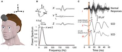 Bone-Conducted oVEMP Latency Delays Assist in the Differential Diagnosis of Large Air-Conducted oVEMP Amplitudes